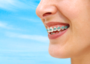 braces for adults in succasunna nj