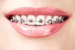 Problems braces can correct