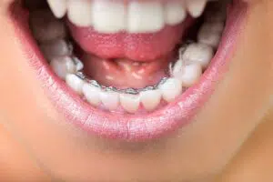 Problems braces can correct
