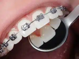Getting Braces as an adult