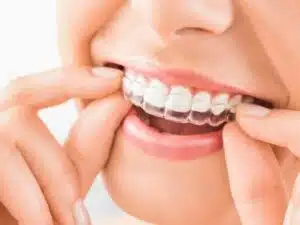 Invisalign Jersey City