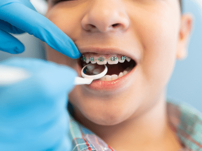 Braces For Kids Morristown NJ - Goldkind Family Ortho