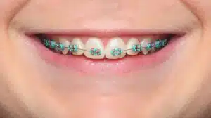 braces for kids