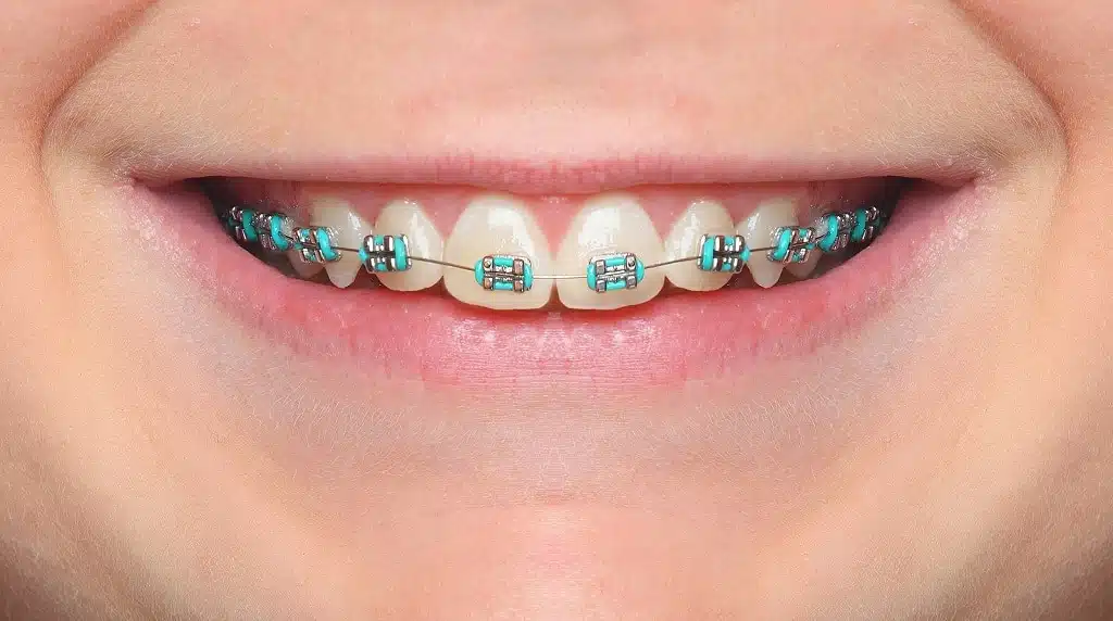 braces for kids