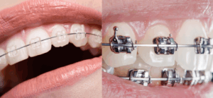 Metal vs Ceramic Braces: Which One’s Right for You?