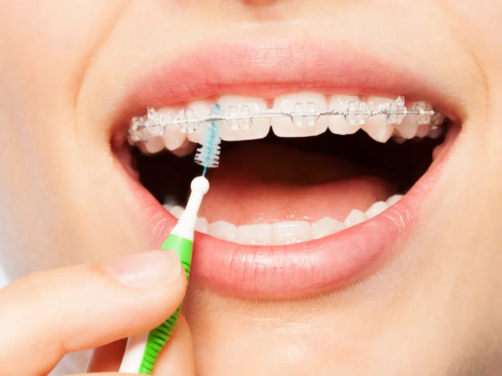 cleaning teeth with braces