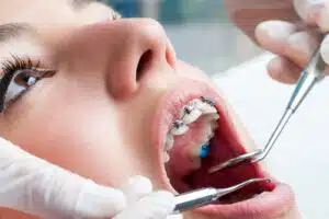 Braces for adults improving smile alignment